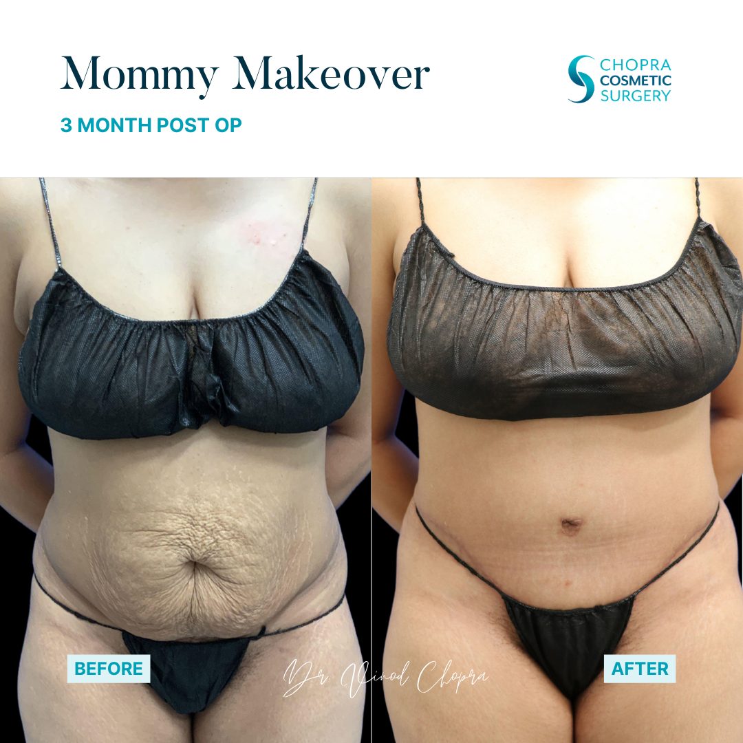 Mommy Makeover Real Patient Results by Dr. Vinod Chopra in Washington, D.C. and Fairfax, VA