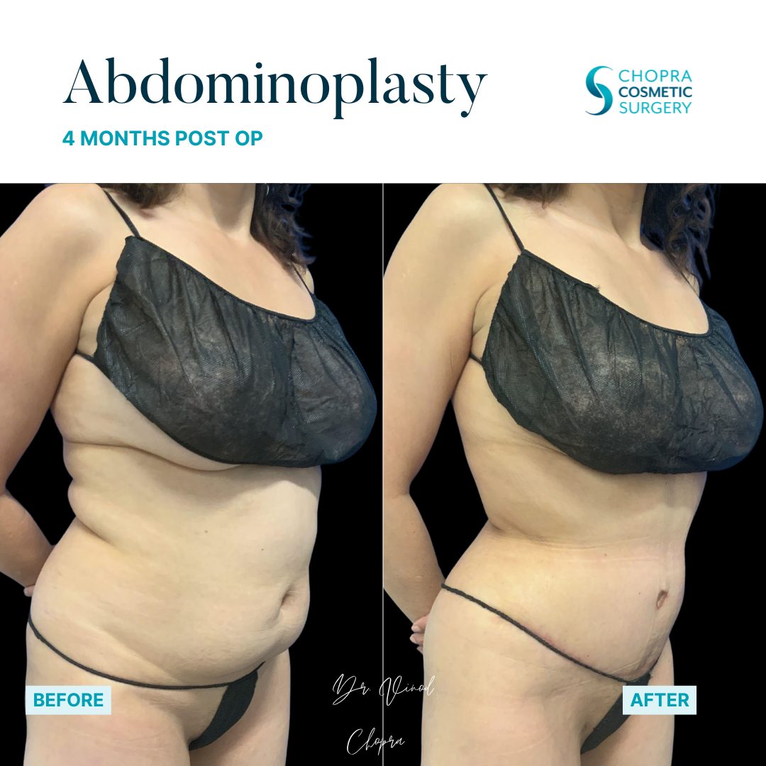 Tummy Tuck Real Patient Results by Dr. Vinod Chopra in Washington, D.C. and Fairfax, VA