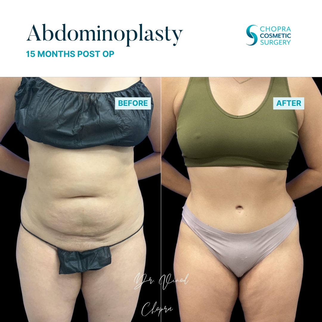 Tummy Tuck Real Patient Results by Dr. Vinod Chopra in Washington, D.C. and Fairfax, VA