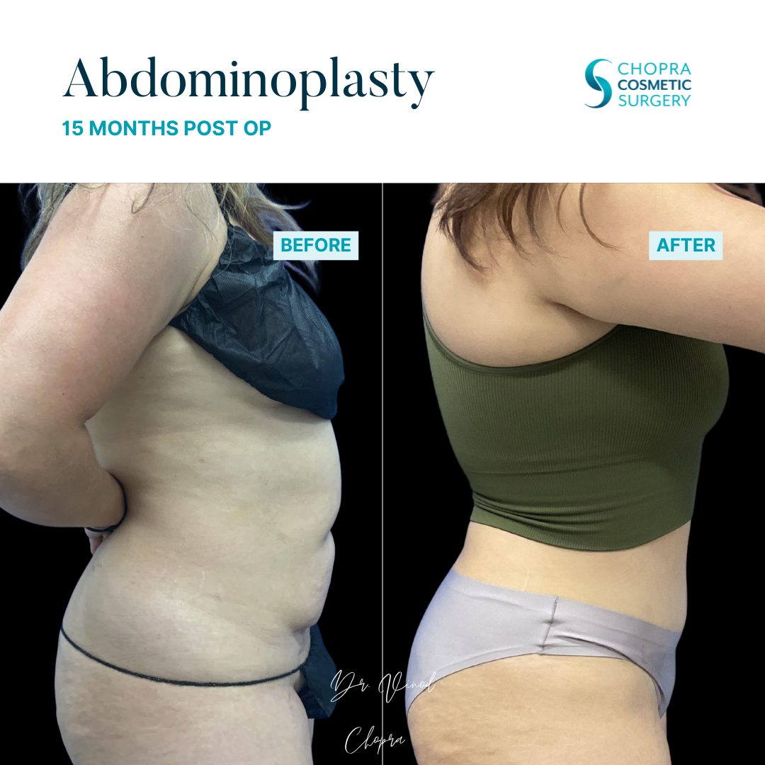 Tummy Tuck Real Patient Results by Dr. Vinod Chopra in Washington, D.C. and Fairfax, VA
