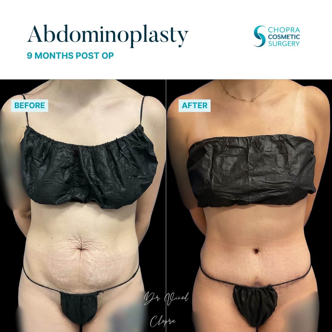 Tummy Tuck Real Patient Results by Dr. Vinod Chopra in Washington, D.C. and Fairfax, VA