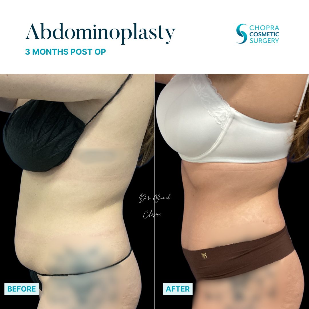 Tummy Tuck Real Patient Results by Dr. Vinod Chopra in Washington, D.C. and Fairfax, VA