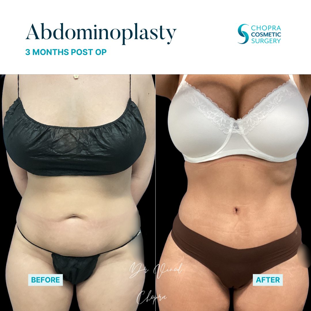 Tummy Tuck Real Patient Results by Dr. Vinod Chopra in Washington, D.C. and Fairfax, VA