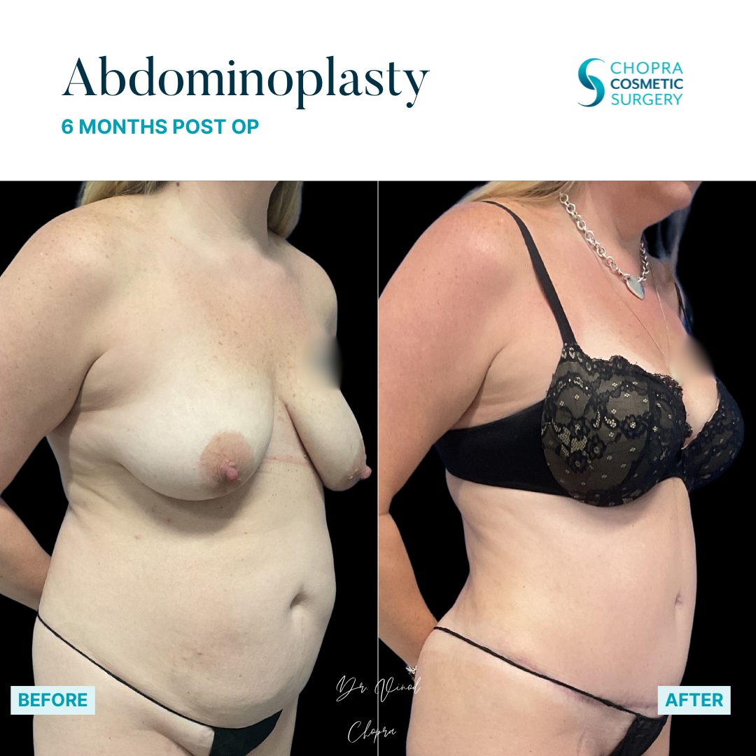 Tummy Tuck Real Patient Results by Dr. Vinod Chopra in Washington, D.C. and Fairfax, VA