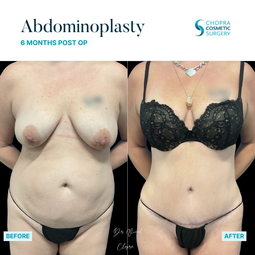 Tummy Tuck Real Patient Results by Dr. Vinod Chopra in Washington, D.C. and Fairfax, VA
