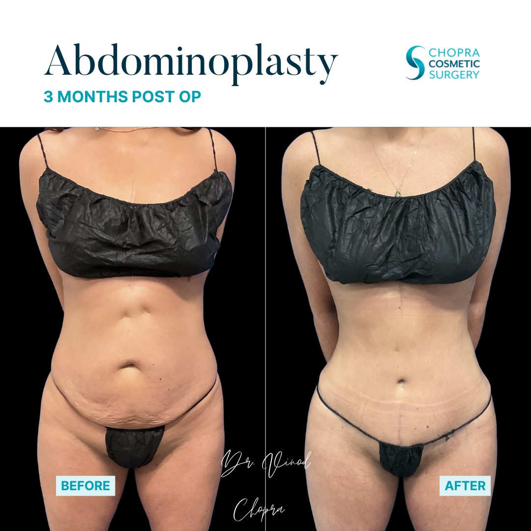 Tummy Tuck Real Patient Results by Dr. Vinod Chopra in Washington, D.C. and Fairfax, VA