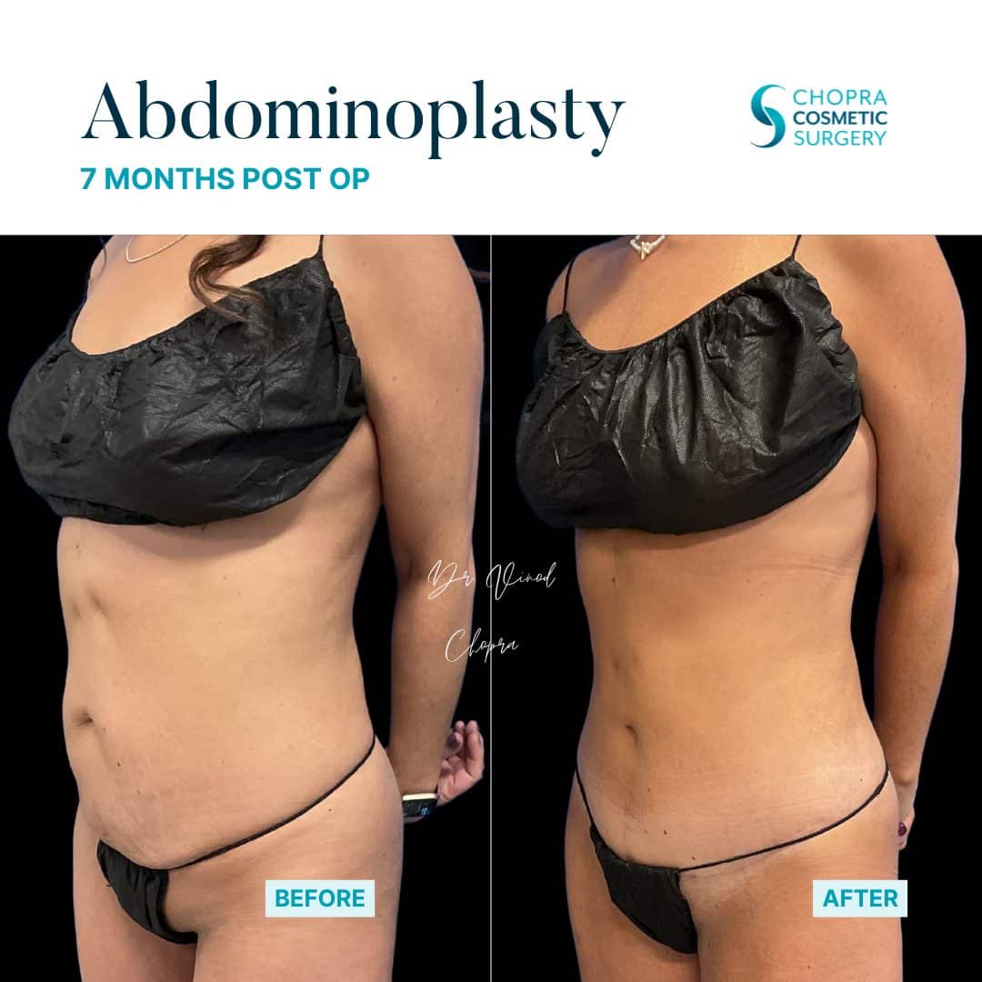 Tummy Tuck Real Patient Results by Dr. Vinod Chopra in Washington, D.C. and Fairfax, VA