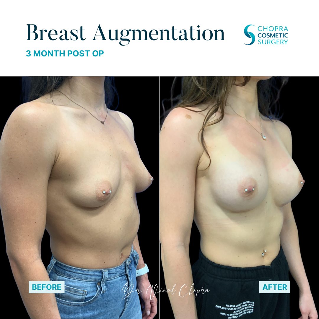 Breast Augmentation Real Patient Results by Dr. Vinod Chopra in Washington, D.C. and Fairfax, VA