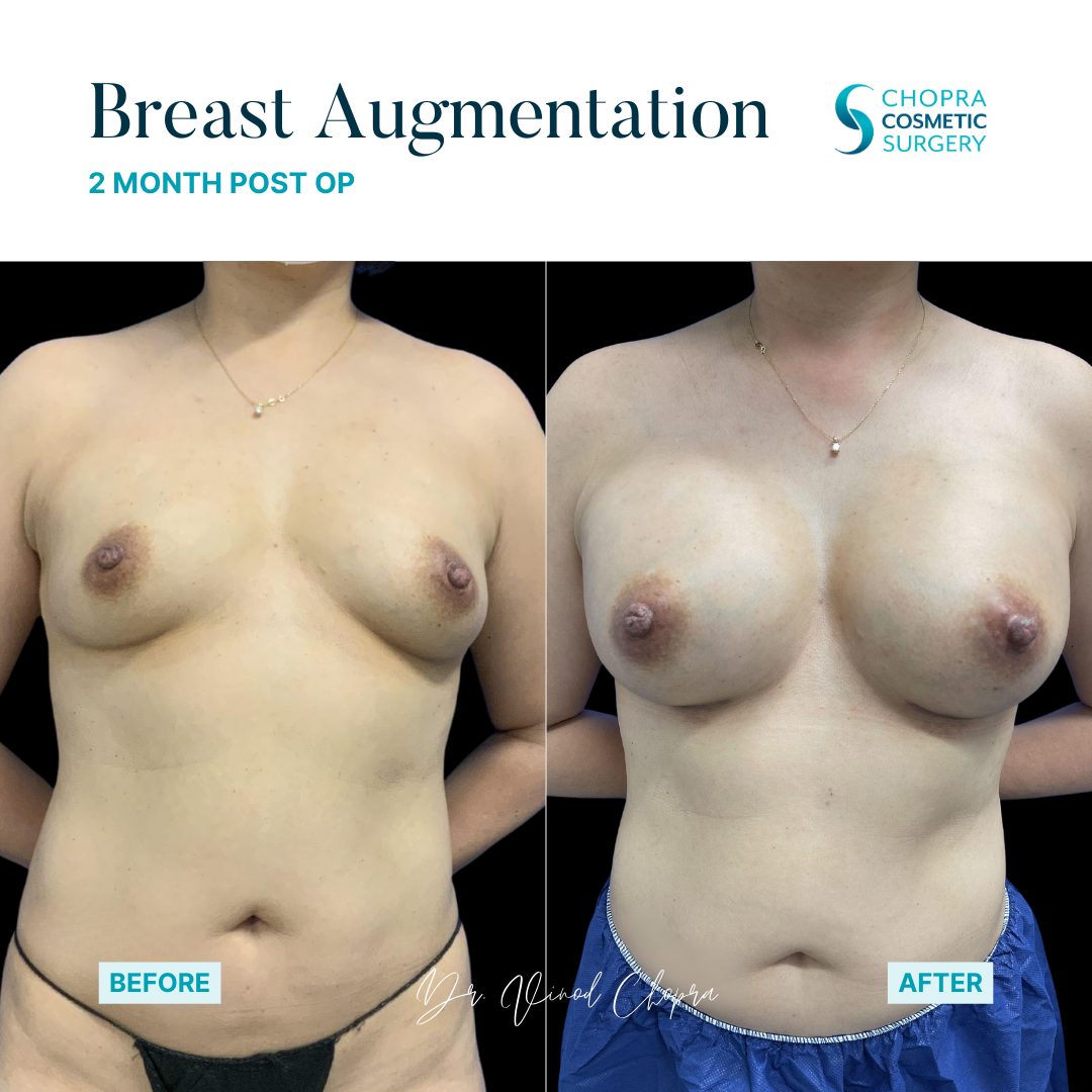 Breast Augmentation Real Patient Results by Dr. Vinod Chopra in Washington, D.C. and Fairfax, VA