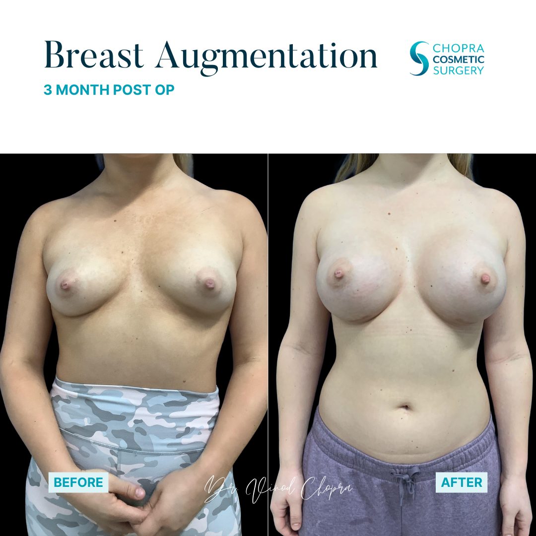Breast Augmentation Real Patient Results by Dr. Vinod Chopra in Washington, D.C. and Fairfax, VA