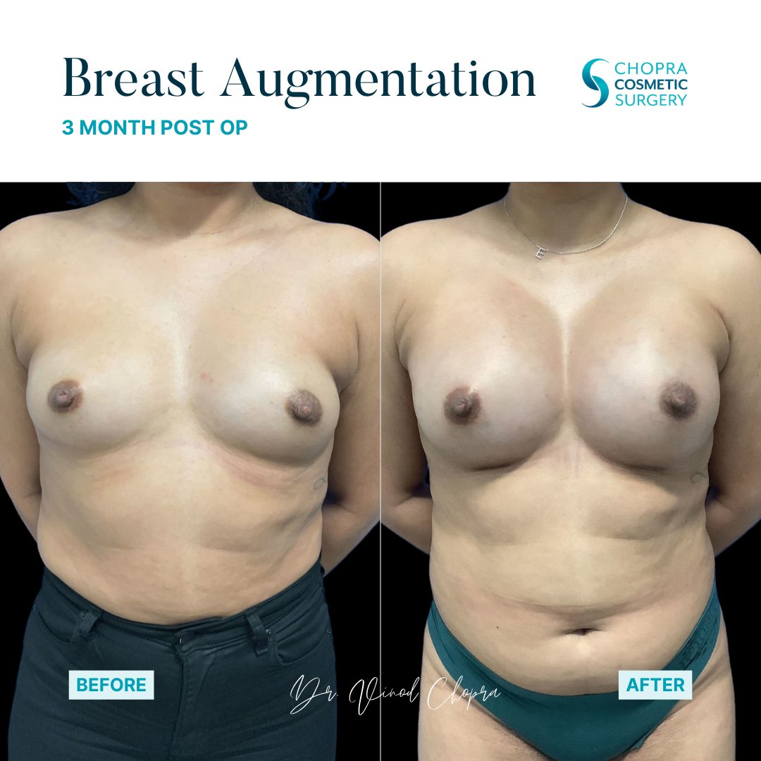 Breast Augmentation Real Patient Results by Dr. Vinod Chopra in Washington, D.C. and Fairfax, VA