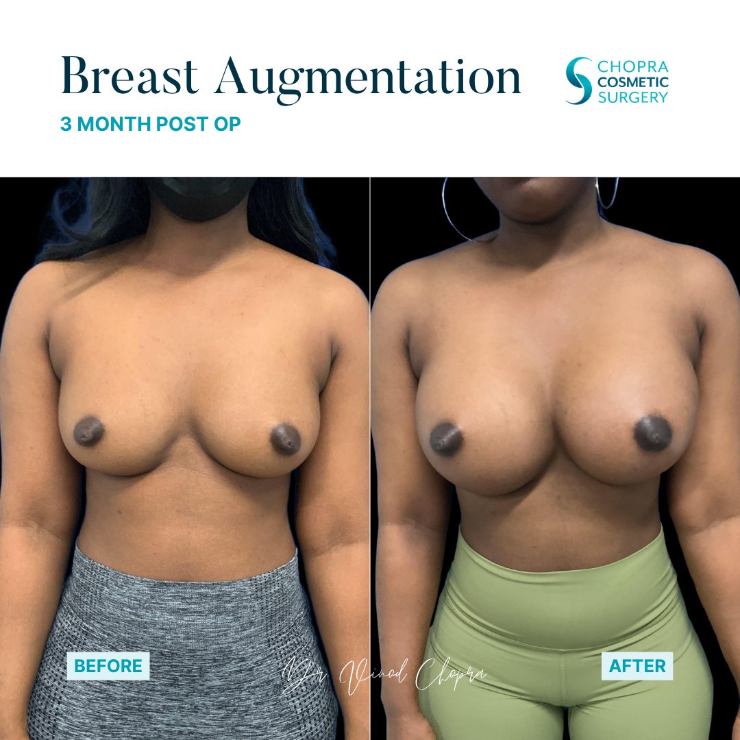 Breast Augmentation Real Patient Results by Dr. Vinod Chopra in Washington, D.C. and Fairfax, VA