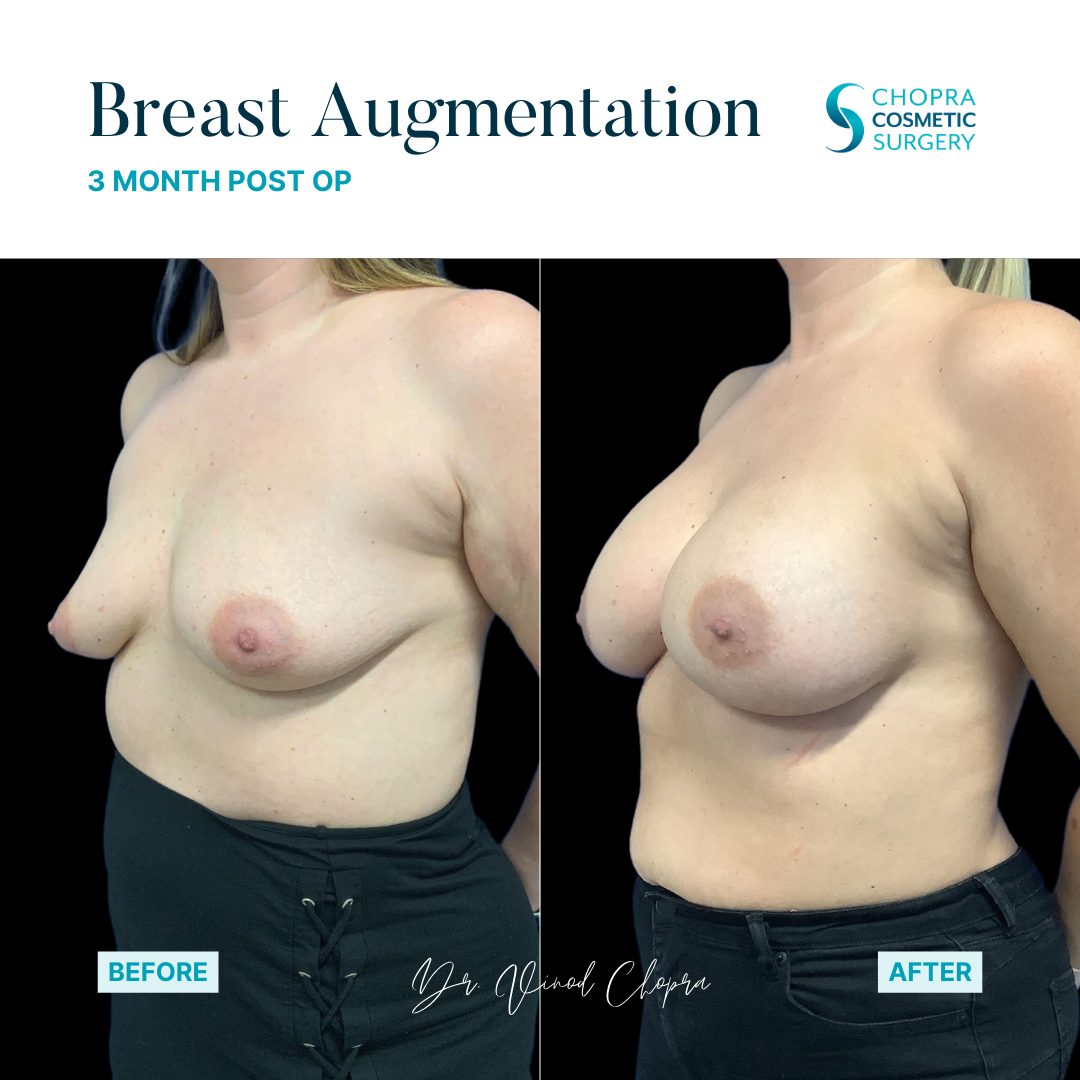 Breast Augmentation Real Patient Results by Dr. Vinod Chopra in Washington, D.C. and Fairfax, VA