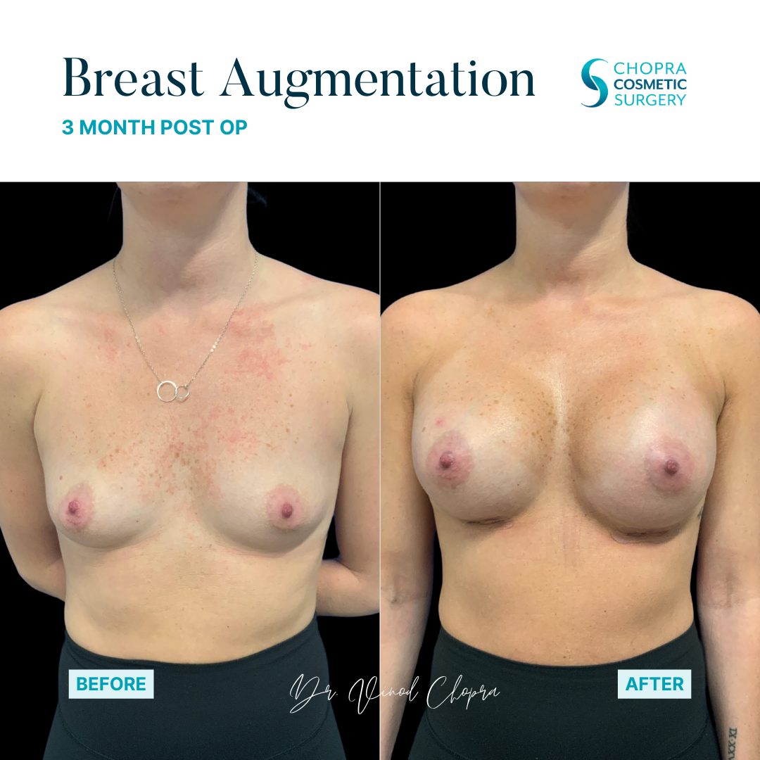 Breast Augmentation Real Patient Results by Dr. Vinod Chopra in Washington, D.C. and Fairfax, VA