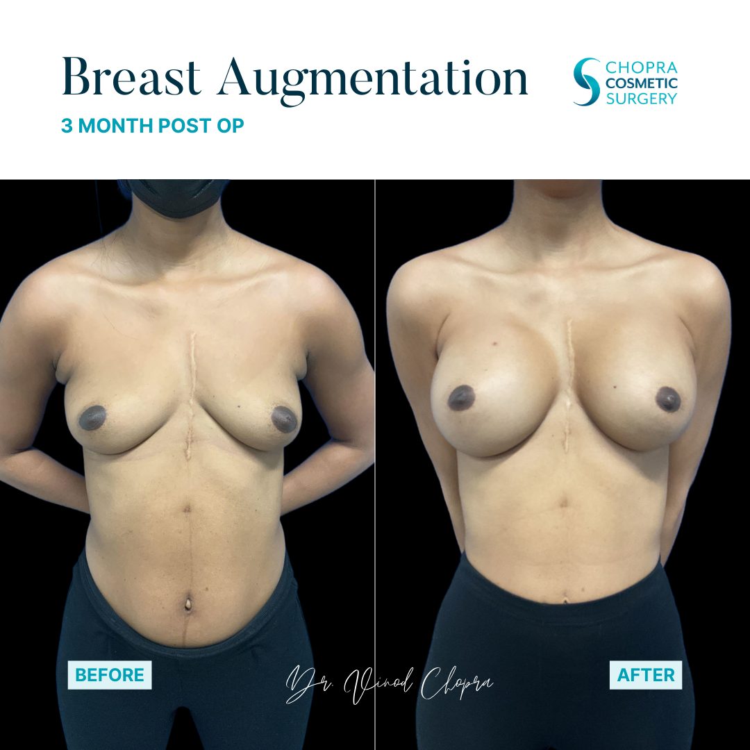 Breast Augmentation Real Patient Results by Dr. Vinod Chopra in Washington, D.C. and Fairfax, VA
