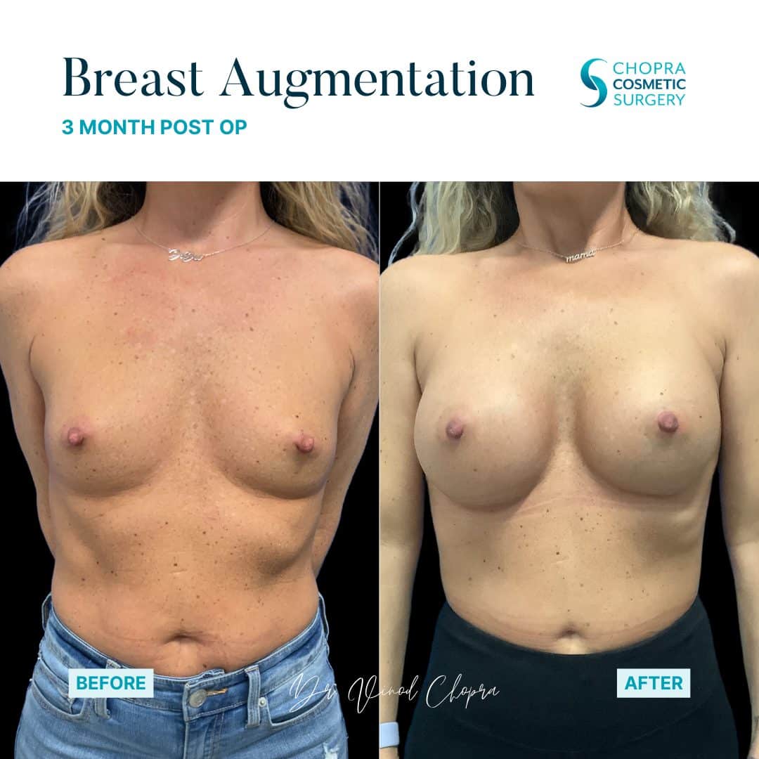 Breast Augmentation Real Patient Results by Dr. Vinod Chopra in Washington, D.C. and Fairfax, VA