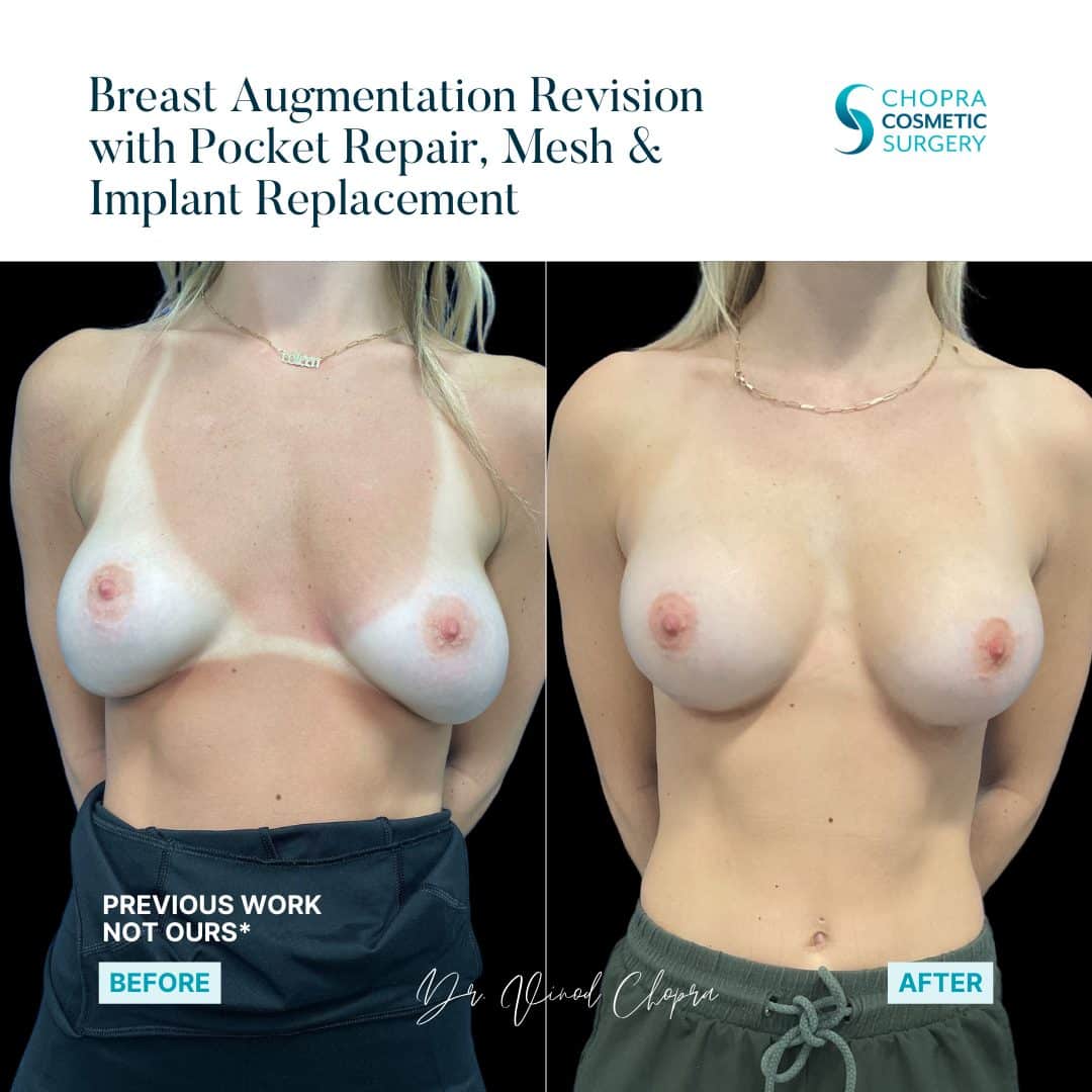 Breast Augmentation Real Patient Results by Dr. Vinod Chopra in Washington, D.C. and Fairfax, VA