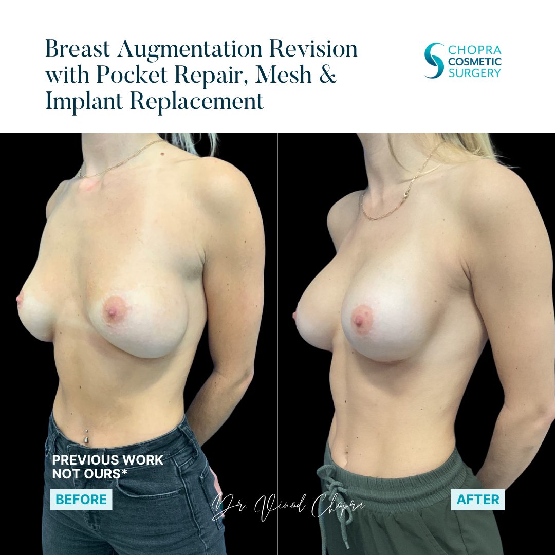 Breast Augmentation Real Patient Results by Dr. Vinod Chopra in Washington, D.C. and Fairfax, VA