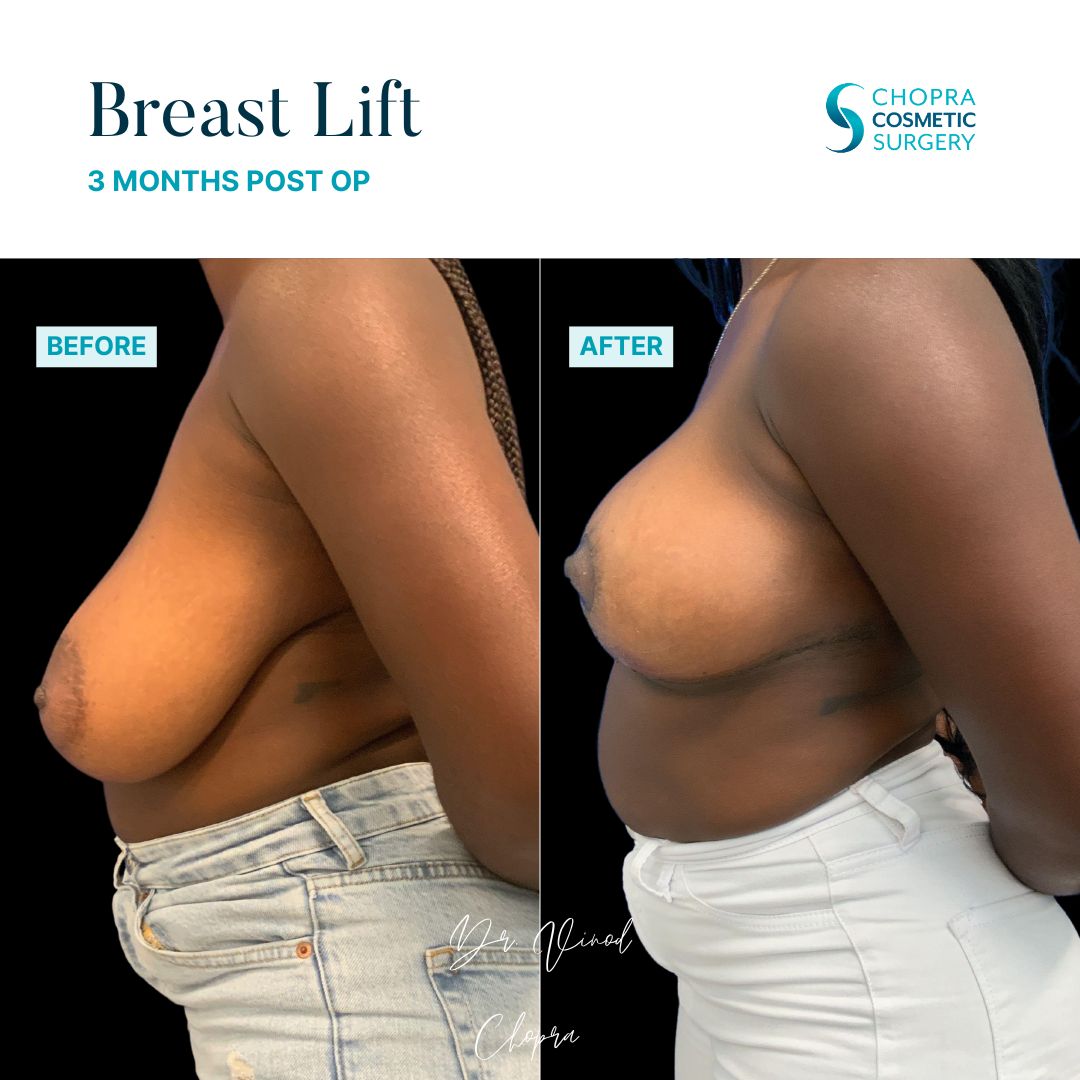 Breast Lift Real Patient Results by Dr. Vinod Chopra in Washington, D.C. and Fairfax, VA