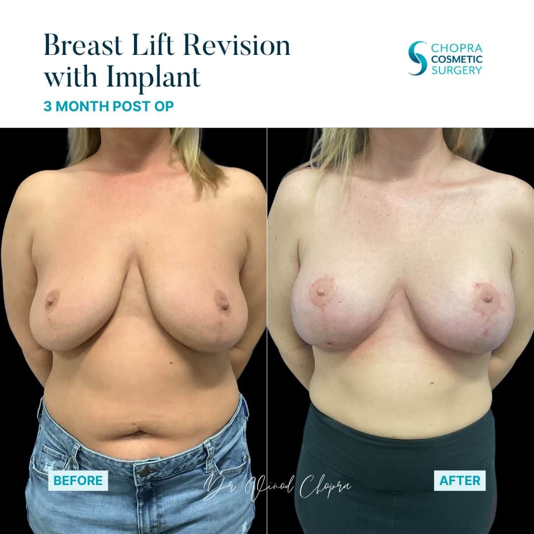 Breast Lift Real Patient Results by Dr. Vinod Chopra in Washington, D.C. and Fairfax, VA