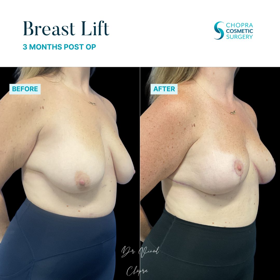 Breast Lift Real Patient Results by Dr. Vinod Chopra in Washington, D.C. and Fairfax, VA