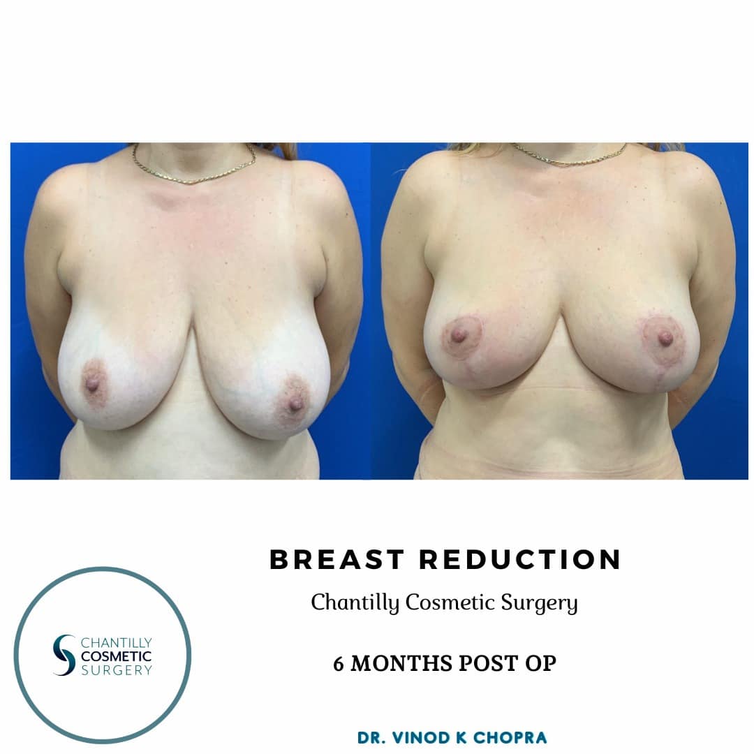 Breast Reduction Real Patient Results by Dr. Vinod Chopra in Washington, D.C. and Fairfax, VA