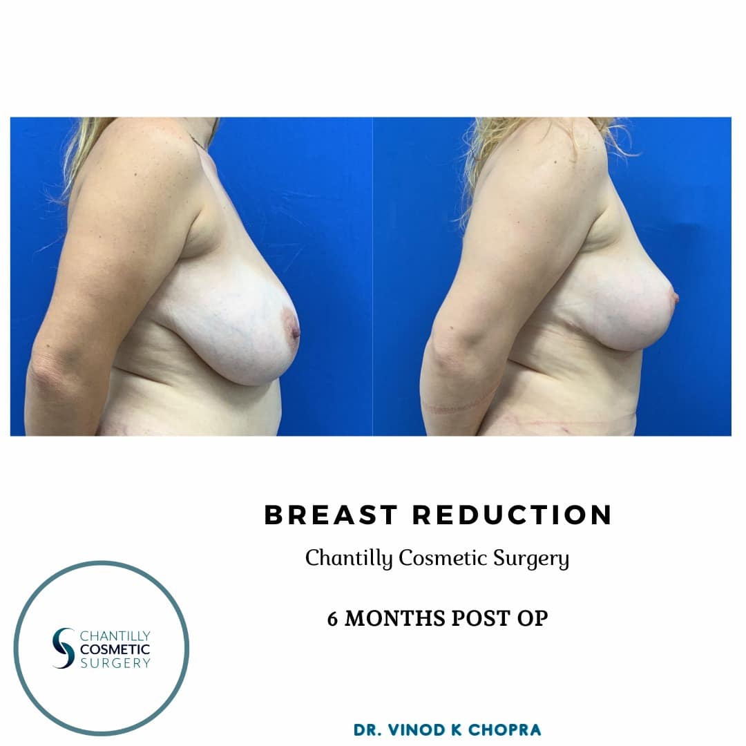 Breast Reduction Real Patient Results by Dr. Vinod Chopra in Washington, D.C. and Fairfax, VA