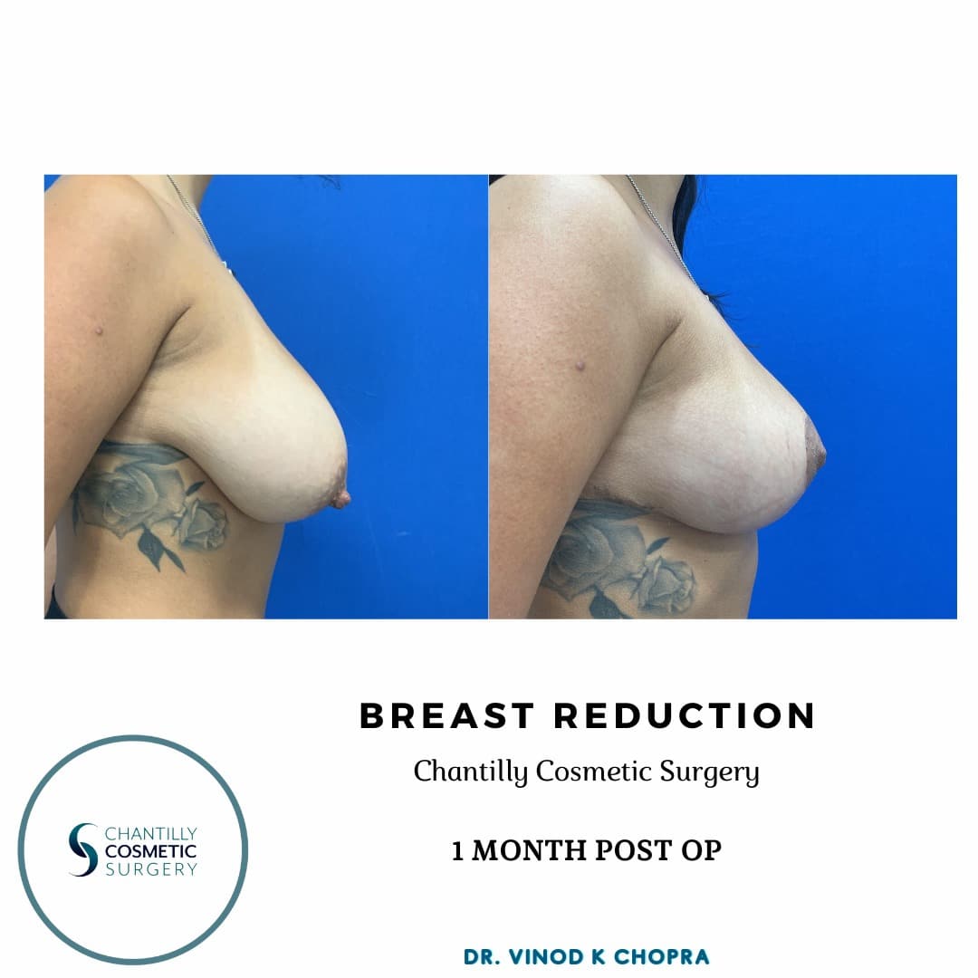 Breast Reduction Real Patient Results by Dr. Vinod Chopra in Washington, D.C. and Fairfax, VA