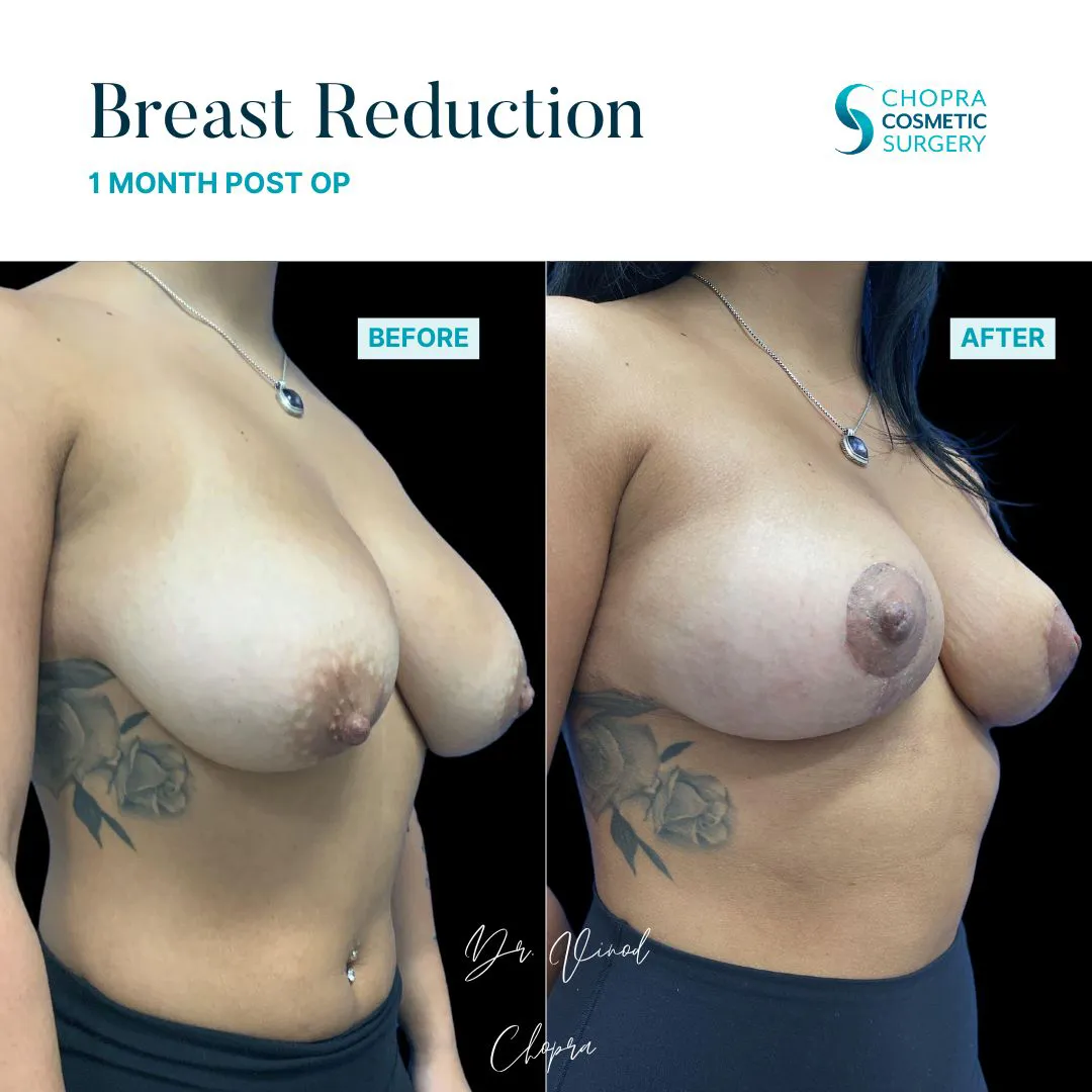 6876BREASTREDUCTION-1