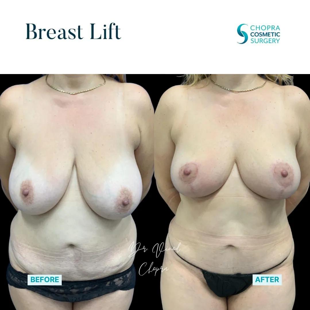 breast-lift-100-1