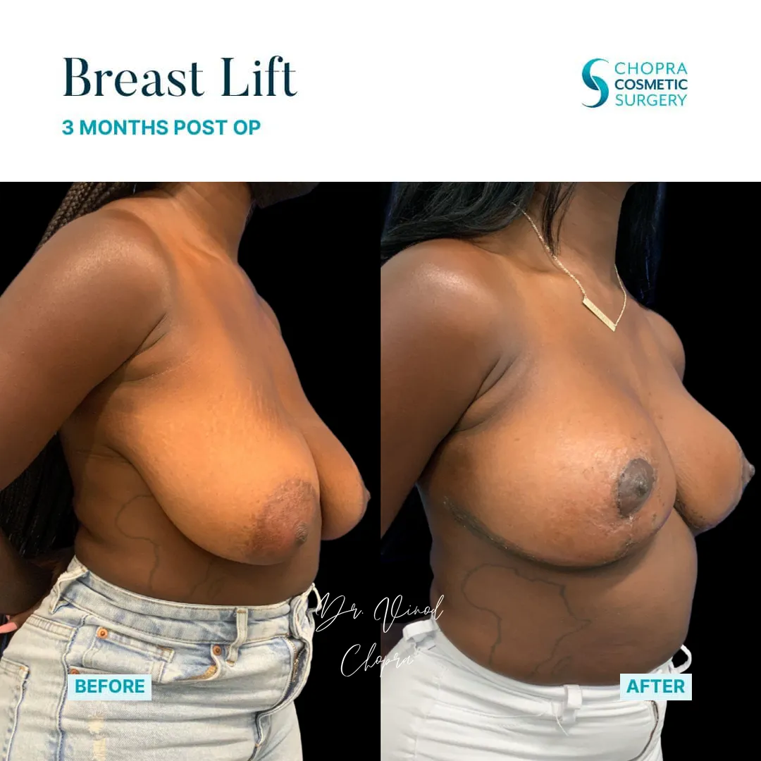 breast-lift-200-1