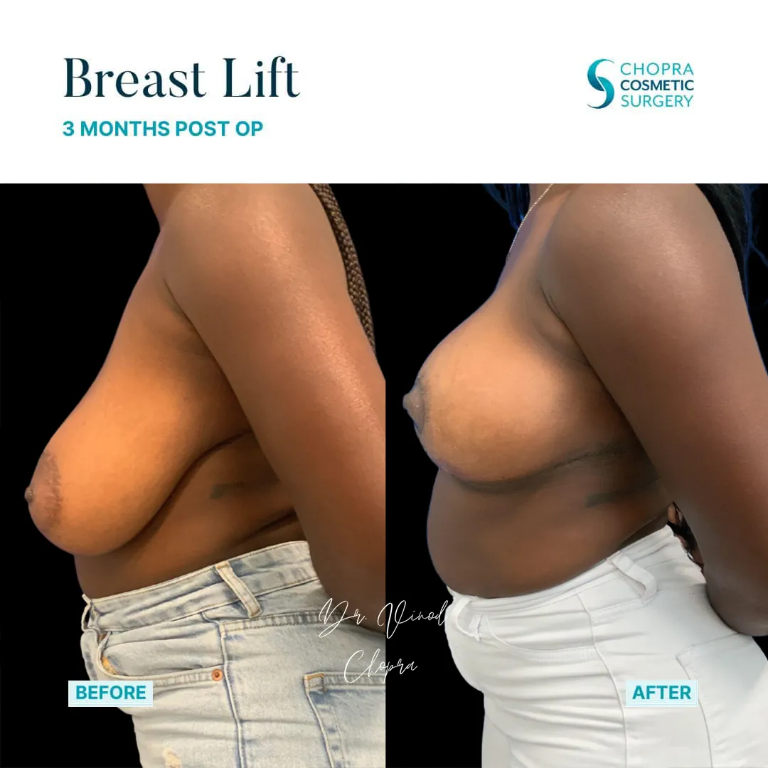 breast-lift-200-2