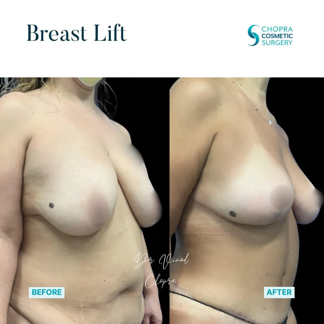 breast-lift-300-1