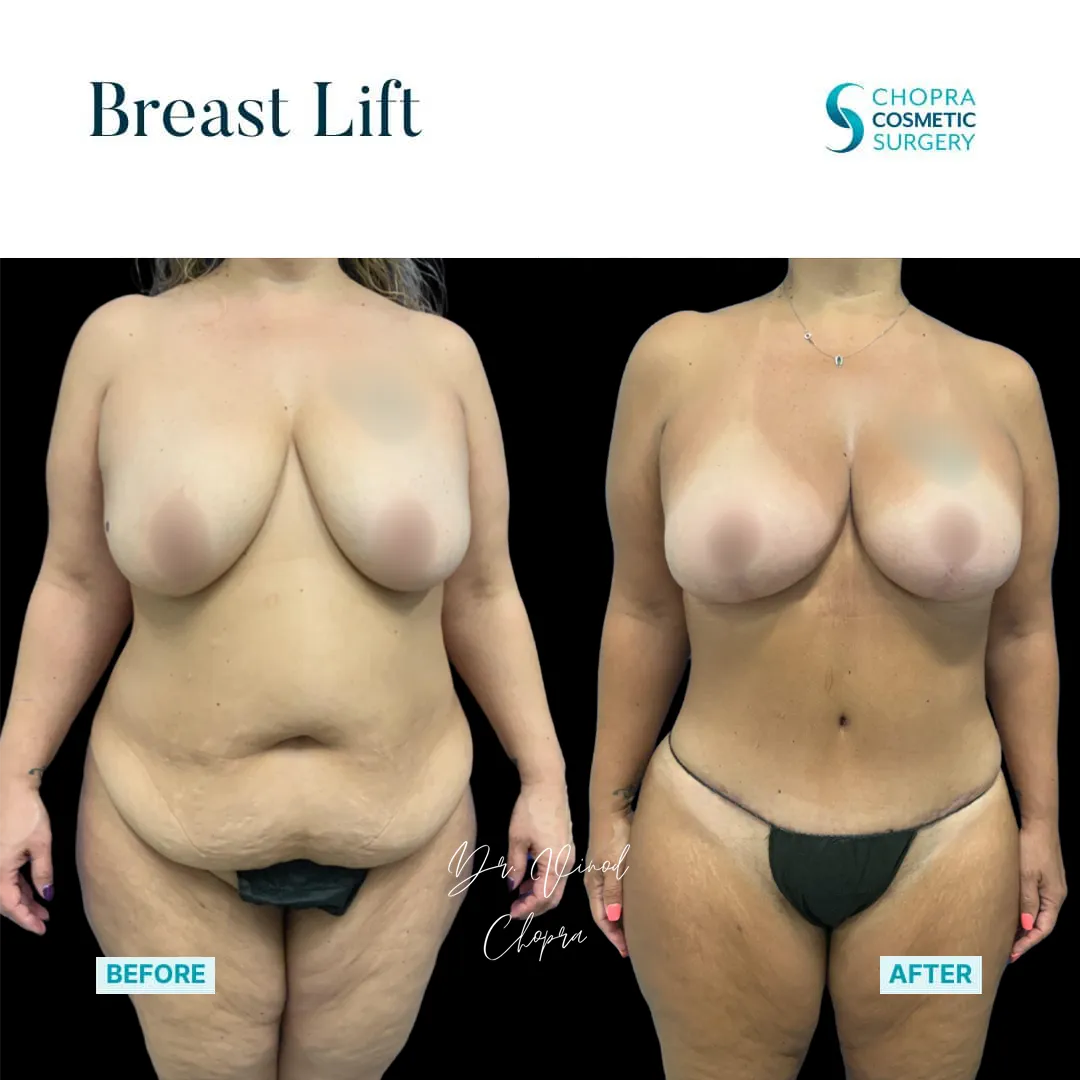 breast-lift-300-2