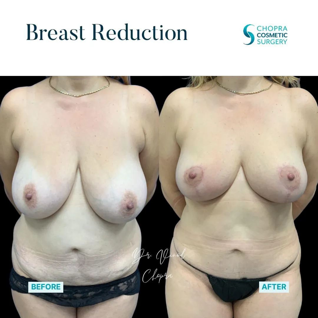 breast-lift-700-1