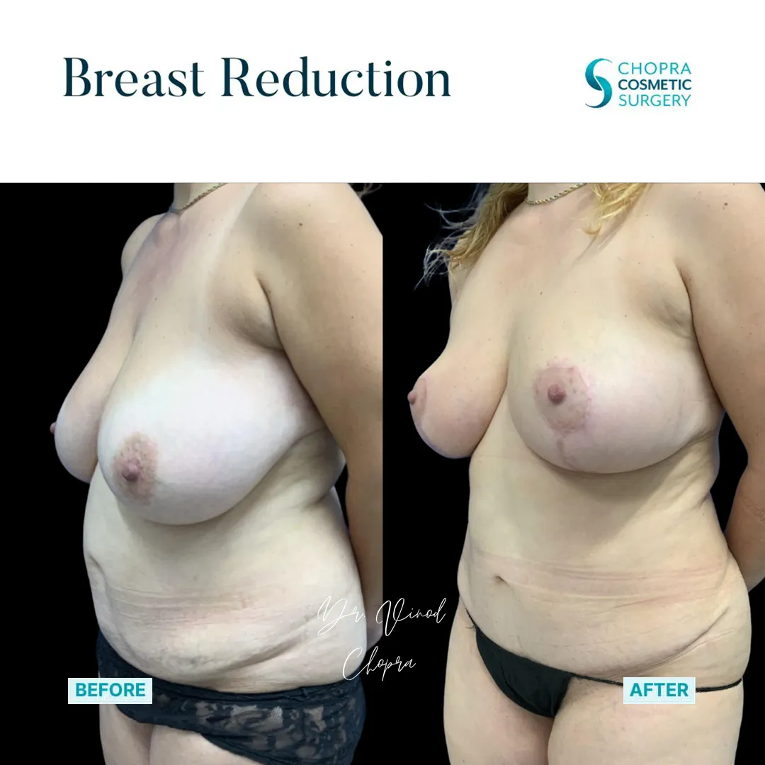 breast-lift-700-2
