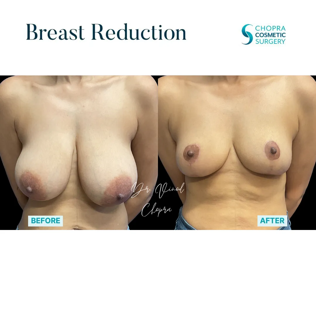 breast-lift-900-1