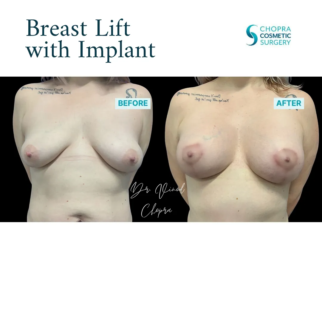 breast-lift-implant-001