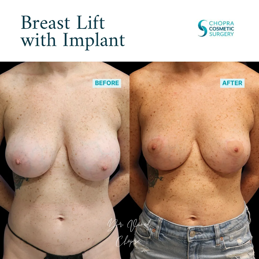 breast-lift-implant-002-1