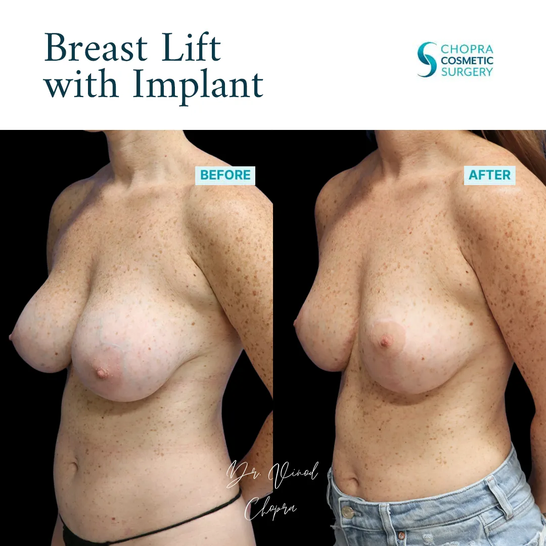 breast-lift-implant-002-2