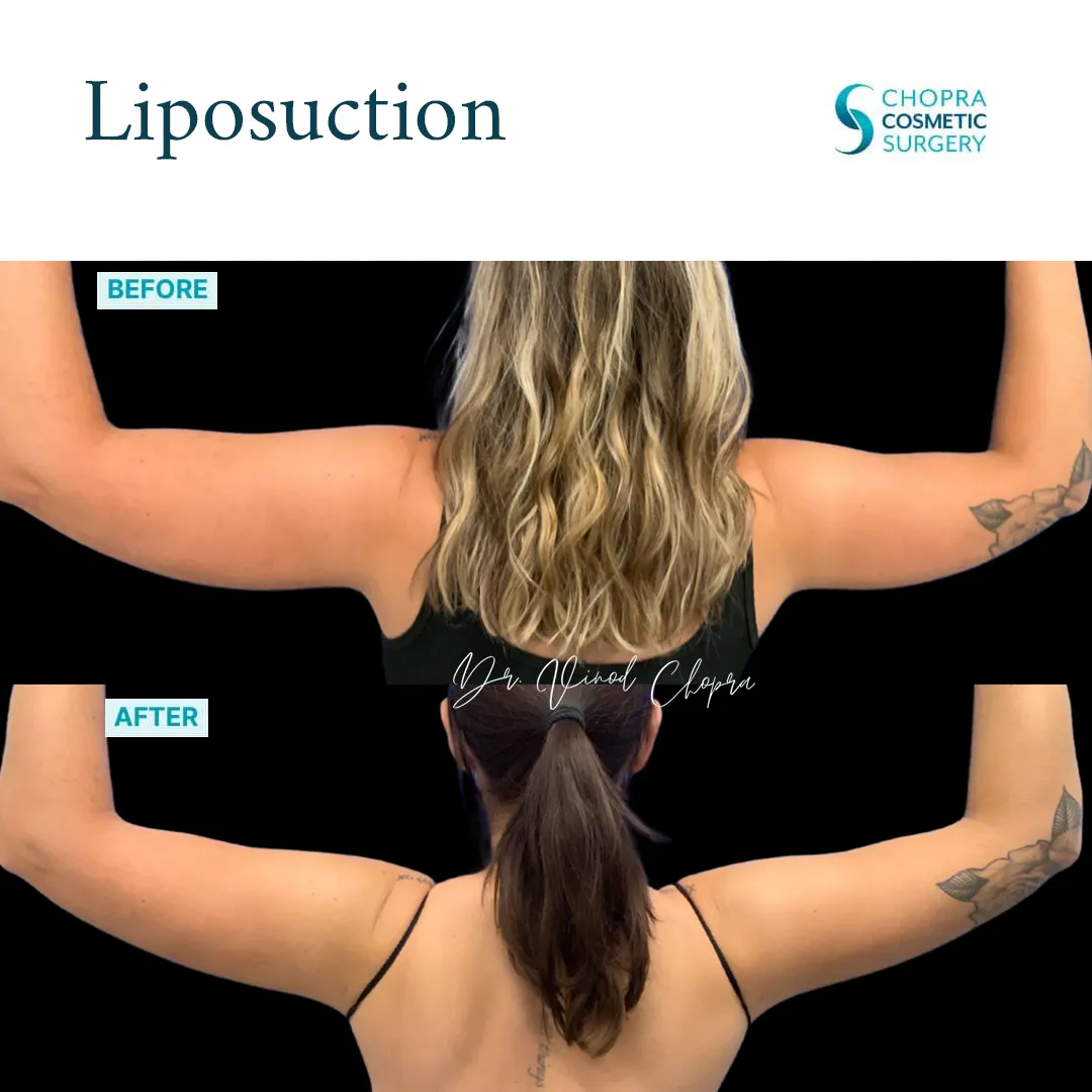 liposuction-200-1