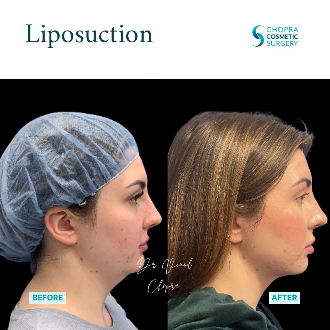 liposuction-300-1