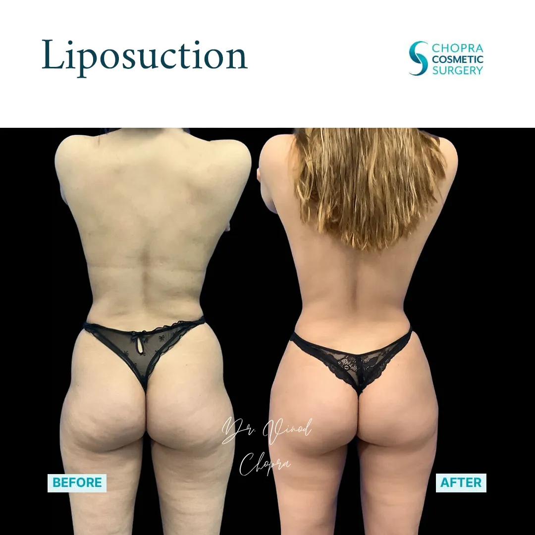 liposuction-400-1