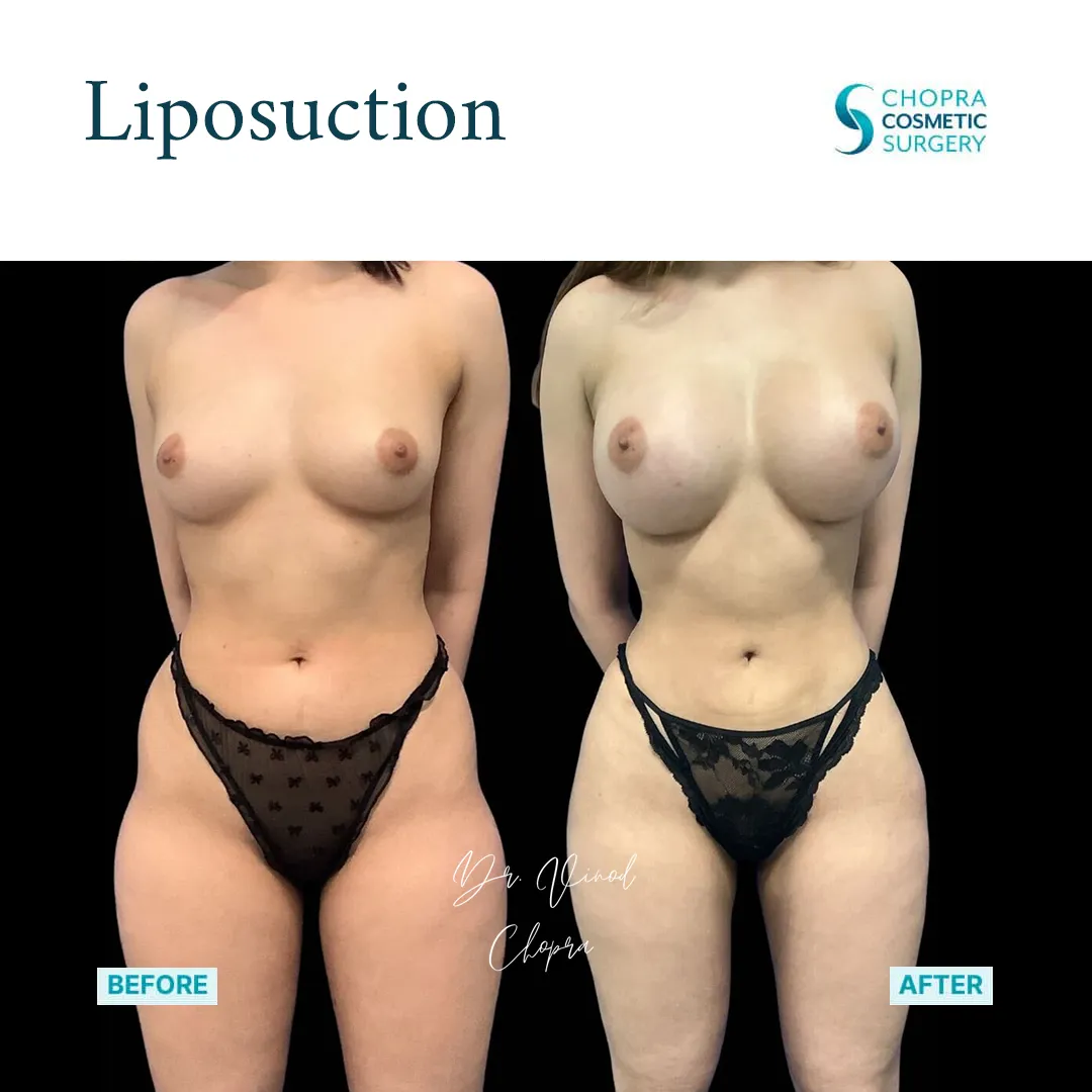liposuction-400-2