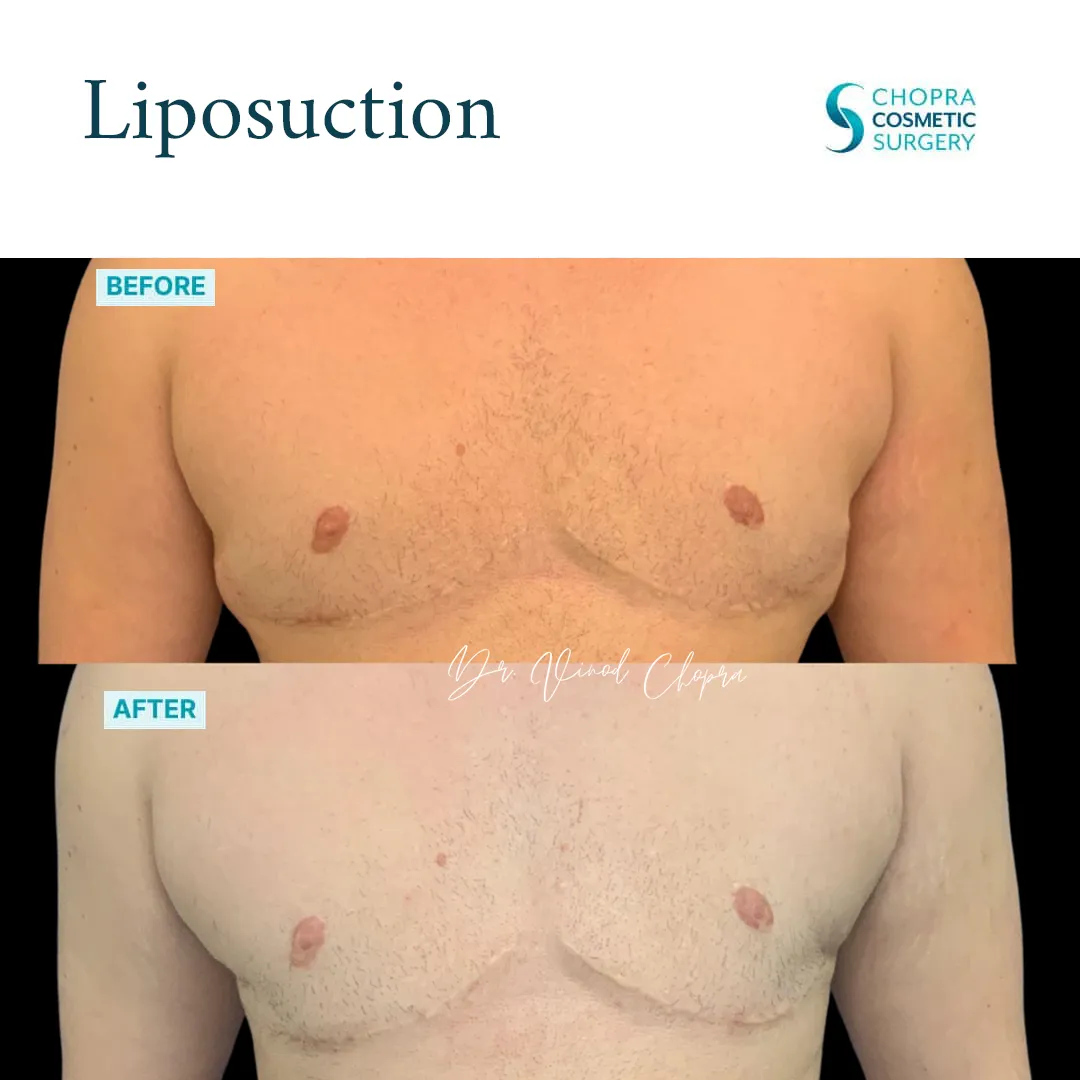 liposuction-500-1