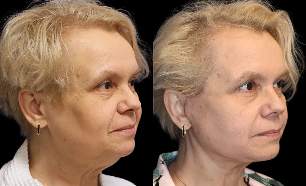 facelift-patient1-01